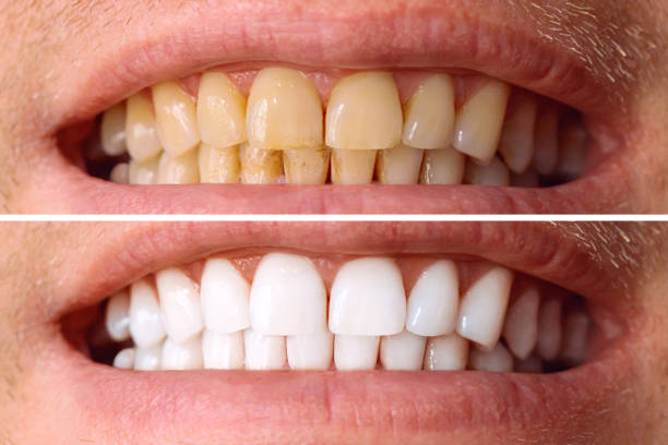 Smile Transformation Case 1