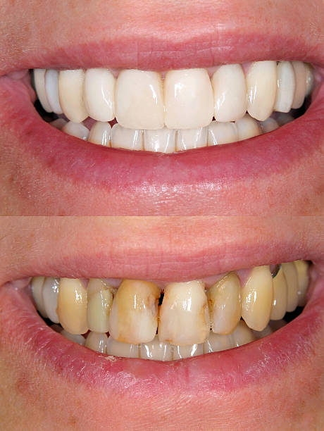 Smile Transformation Case 3