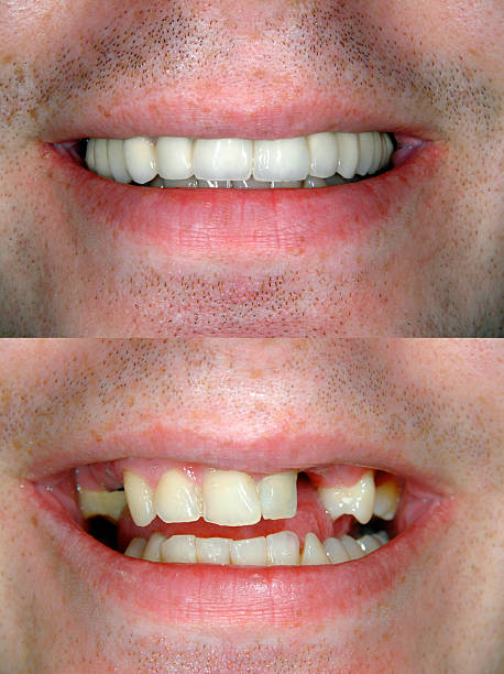 Smile Transformation Case 6